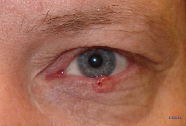 dešinės akies hipertenzija vyrų hipertenzijos priežastys