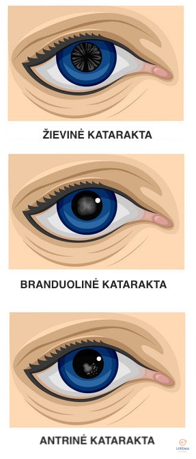 Kataraktos tipai